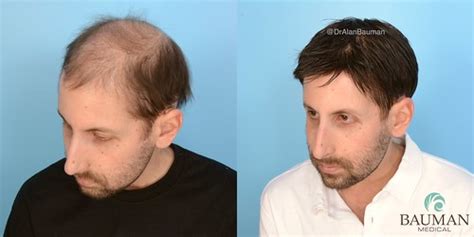 cnc hair system|CNC 3D Cranial Prosthesis .